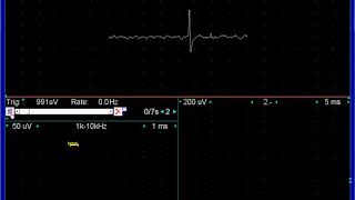 end plate noise and spikes [upl. by Hobie]