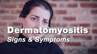 Dermatomyositis – Signs amp Symptoms  Johns Hopkins [upl. by Aleibarg]