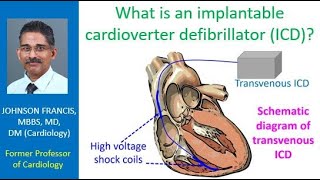 What is an implantable cardioverter defibrillator ICD [upl. by Brade]