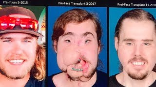 Face transplant patient reveals his incredible transformation [upl. by Hsizan]