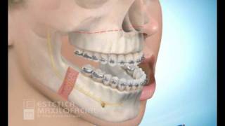 Cirugia maxilofacial  Avance del maxilar superior con retroceso mandibular [upl. by Ettenim]