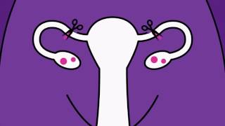 Brook Contraception  Sterilisation Animation [upl. by Lindsley]