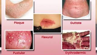 Different types of psoriasis pictures images photos [upl. by Jessabell385]