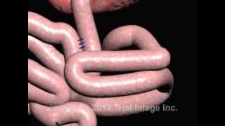 Intussusception of the Bowel video  Animation by Cal Shipley MD [upl. by Irrok540]