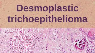 Desmoplastic Trichoepithelioma  Pathology mini tutorial [upl. by Annohsal]