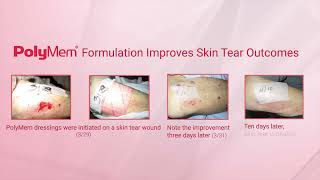 PolyMem Formulation Improves Skin Tear Outcomes [upl. by Aehsan909]