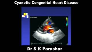 Cyanotic Congenital Heart Disease Dr S K Parashar [upl. by Canon]