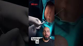 Colocación de catéter epidural [upl. by Kilam]