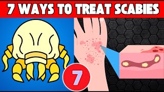 7 Best Ways To Treat Scabies Faster Get relief from itch [upl. by Singleton675]