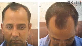 Hair Transplant in Karachi  Amazing Results By AlKhaleej Clinics [upl. by Neel]