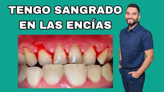 TENGO SANGRADO EN LAS ENCÍAS  ENCÍAS SANGRANTES  DR DAVID CAMPOS [upl. by Aiket]