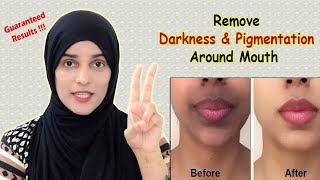 How to Remove Dark Upper Lips  Black patches Dark Spots Hyper pigmentation around Mouth [upl. by Sena]