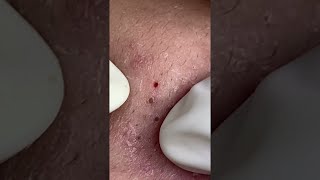 Big Cystic Acne Blackheads Extraction Blackheads amp Milia Whiteheads Removal Pimple Popping shorts [upl. by Atidnan]