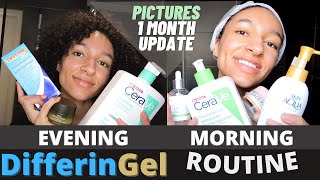 SKINCARE ROUTINE WITH DIFFERIN GEL  FIRST MONTH USING DIFFERIN  DIFFERIN BEFORE AND AFTER PICTURES [upl. by Nairred]