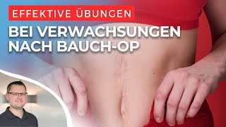 Verwachsungen nach Bauch OP  das kannst du tun [upl. by Quickman]