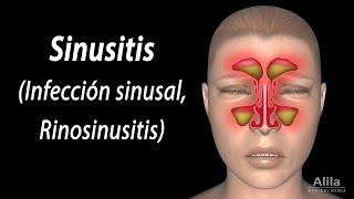 Sinusitis Animación Alila Medical Media Español [upl. by Ulund]