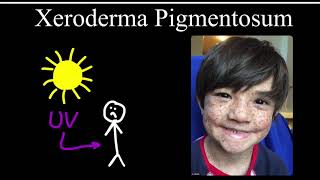 Xeroderma Pigmentosum [upl. by Nnawtna]