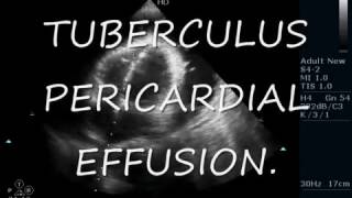 TUBERCULUS PERICARDIAL EFFUSION  ECHOCARDIOGRAPHY SERIES BY DR ANKUR K CHAUDHARI [upl. by Aliel581]