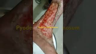 The Truth About Pyoderma Gangrenousum [upl. by Gnut57]