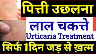 सिर्फ 1 दिन में पित्ती को जड़ से उखाड़ देगी ये दवा  Urticaria Treatment In Hindi  पित्ती का इलाज [upl. by Diane-Marie]