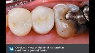 How to Adjust and Polish FullContour Zirconia Crowns [upl. by Retxab]