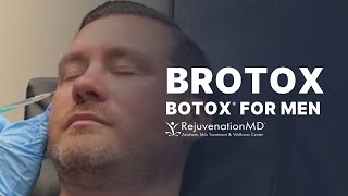 Botox for Men Treat Crow’s Feet Glabella and Forehead [upl. by Asenad]