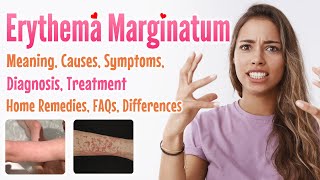 Erythema marginatum overview meaning signs and symptoms diagnosis treatment home remedies FAQs [upl. by Tutto173]