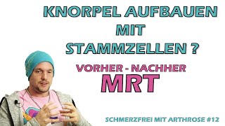 Stammzellen Knorpel aufbauen Stammzelltherapie Vorher  Nachher MRT Schmerzfrei mit Arthrose 12 [upl. by Nayve]