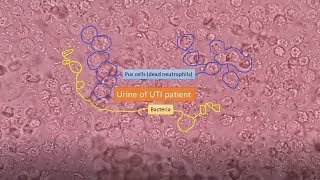 Urine of UTI patient under the Microscope [upl. by Notlih]