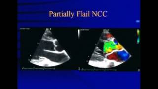 Aortic Regurgition Dr S K Parashar [upl. by Teeter]