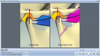 TMJ Disorders [upl. by Janna]