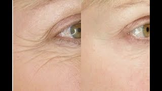 Best Face Yoga Exercise for Eye Wrinkles  FACEROBICS® [upl. by Brathwaite]