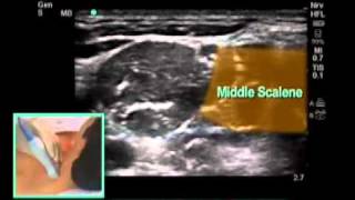 UltrasoundGuided Interscalene Brachial Plexus Nerve Block  SonoSitemp4 [upl. by Bidle]