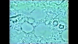 Parodontite de grossesse  biofilm sous épulis [upl. by Cordie560]