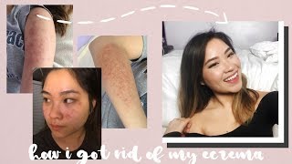 HOW I GOT RID OF ECZEMA  NUMMULAR [upl. by Boehike]