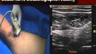 Ultrasonographic Anatomy Sciatic Nerve [upl. by Oinesra522]