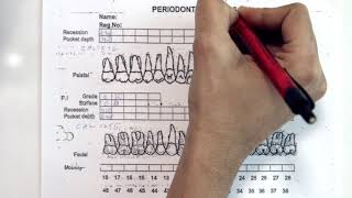 Periodontal Charting [upl. by Leonie]