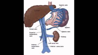 Distal Splenorenal Shunt  Presentation [upl. by Pollyanna912]