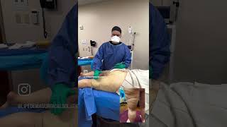 Lipedema Reduction Surgery Addressing Lateral Thighs Hips and Buttocks Inflammation lipedema [upl. by Laamaj]