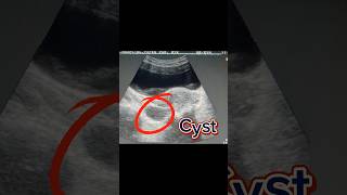 Bulky Uterus  Retroverted Uterus  Ovary Cyst  Simple Cyst on Ultrasound [upl. by Accem]