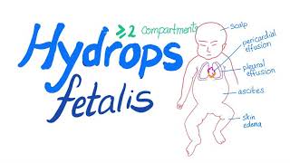 Hydrops fetalis [upl. by Noiemad]