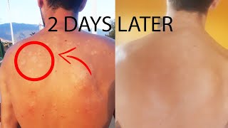 How I cured Tinea Versicolor in 2 days forever [upl. by Merras118]