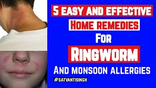 5 Easy amp Effective Home Remedies For Ringworm and monsoon allergies [upl. by Orly]