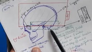 Prophylactic cranial irradiation Craniospinal irradiation German helmet technique PCI CSI WBRT [upl. by Enerak]