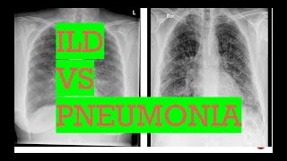 Peak Flow and Spirometry  Lung Function Tests [upl. by Chryste]