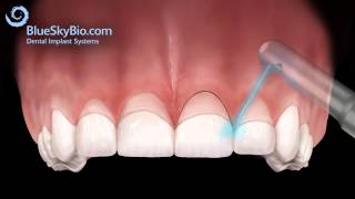 Patient Treatment Videos Gingivectomy [upl. by Gensmer835]