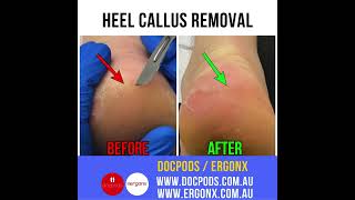 Heel callus removal [upl. by Nitaj]