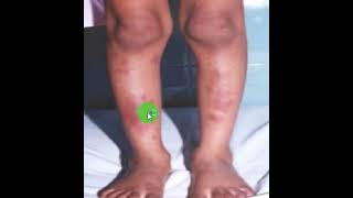 7 Erythema nodosum مرض الحمامي العقدية [upl. by Ghiselin]