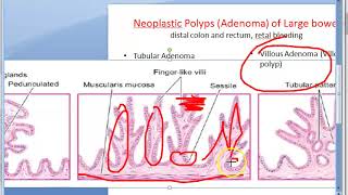 Pathology 521 g Neoplastic polyp tubular adenomatous villous papilloma tubulovillous papillary [upl. by Gombosi]