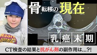 【乳がん末期抗がん剤治療中】現在の骨転移の状態報告！脱毛はどうなった？！ [upl. by Einuj61]